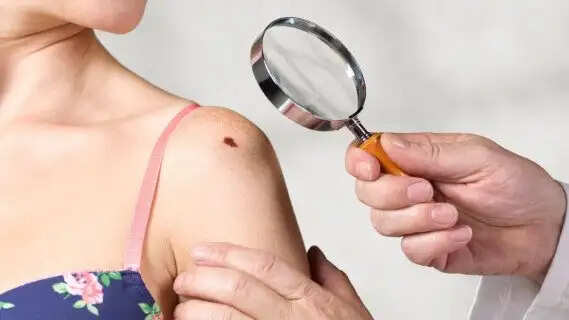 More Than Just a Mole: The Hidden Symptoms You Shouldn’t Ignore
