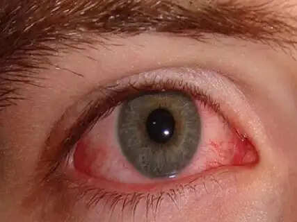 Beware of Office Pink Eye: Your Shared Keyboard and Desk Can Spread Conjunctivitis This Monsoon
