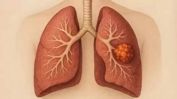 World Lung Cancer Day 2025: Beyond Smoking – Understanding Other Causes
