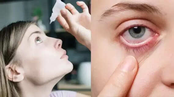 How to Treat and Prevent Eye Irritation & Conjunctivitis (Pink Eye): Expert Tips for the Rainy Season