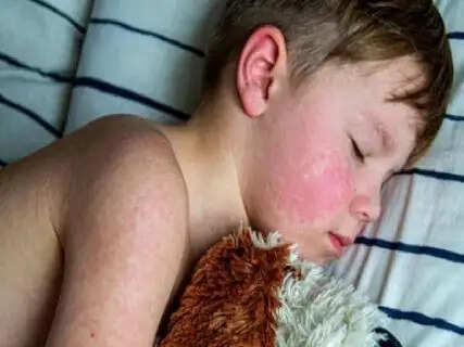 The world's most infectious disease discovered in California – but mistaking it for a rash or the flu could lead to death.
